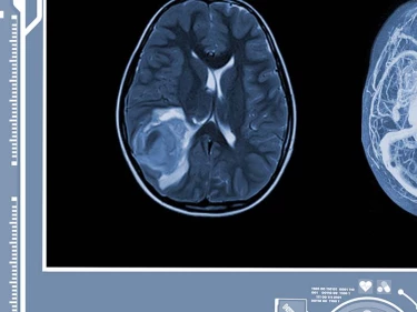 Brain bleed symptoms include visible hemorrhaging on a brain scan.