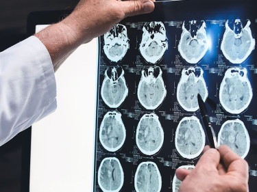 Doctor reviewing brain scans to identify brain bleed symptoms