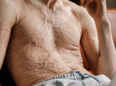 Man with a healing burn injury using a laptop at home