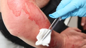 Medical professional treating severe burn injury on patient arm in clinical setting